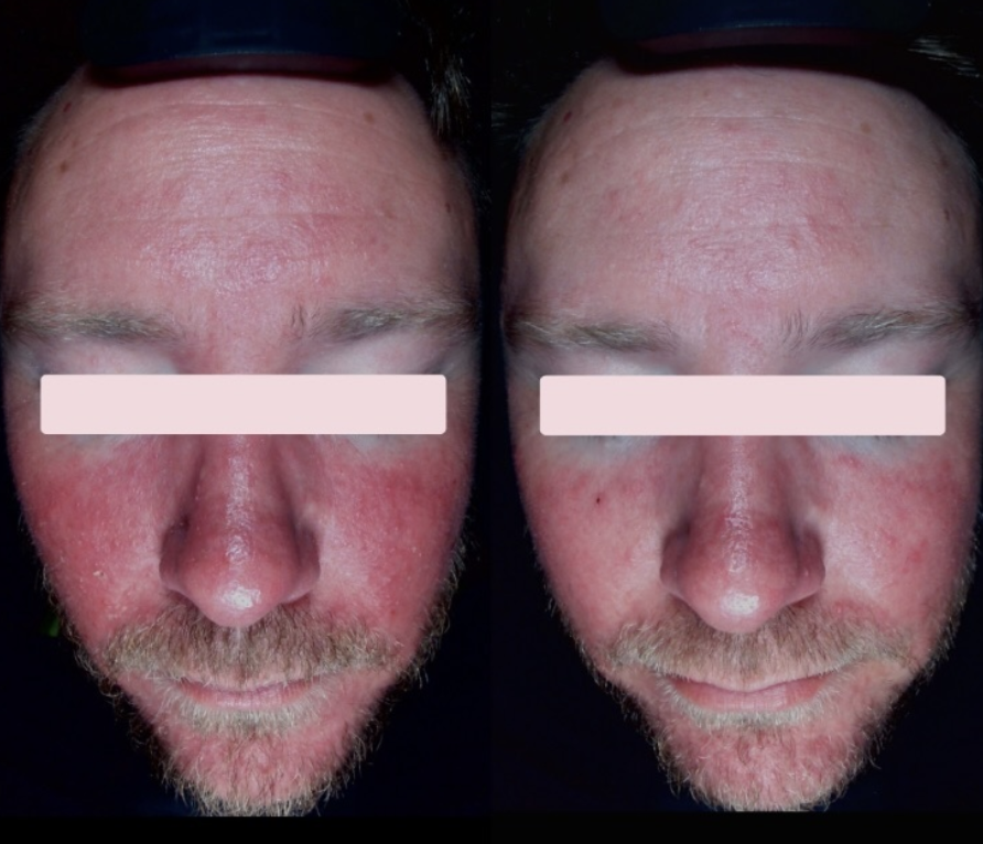Client skin results before and after treatment at The Skin Bar and Lounge