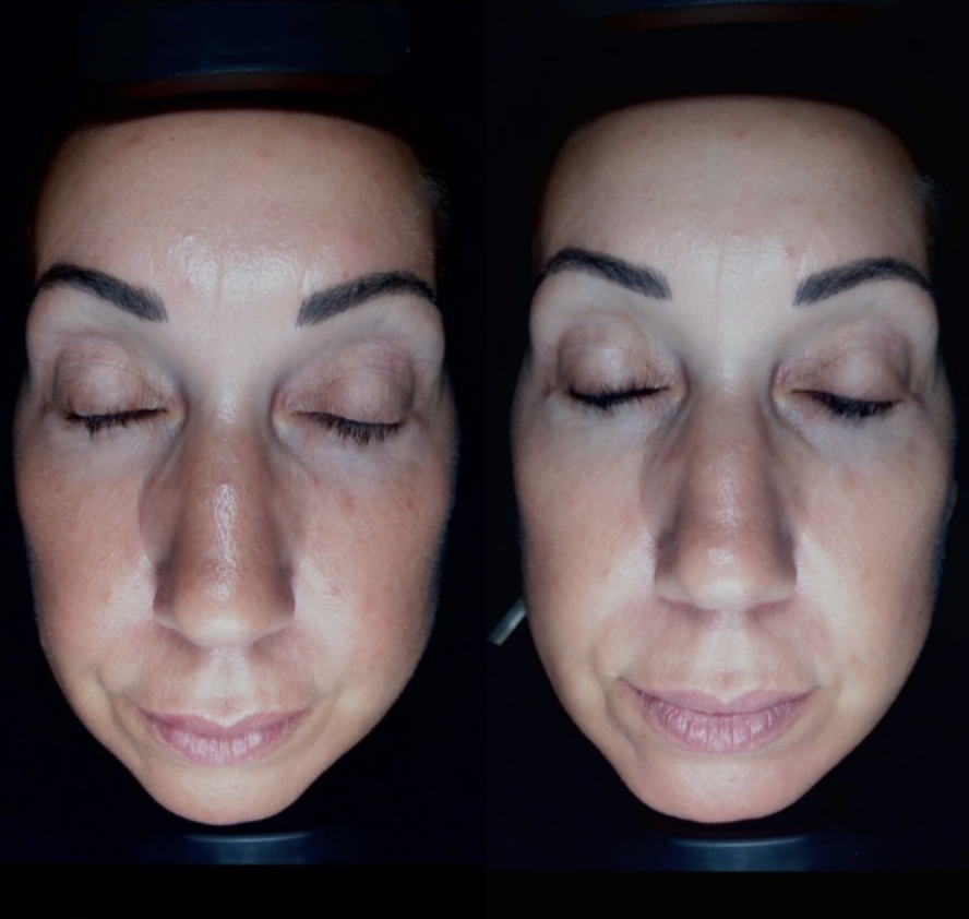 Client skin results before and after treatment at The Skin Bar and Lounge
