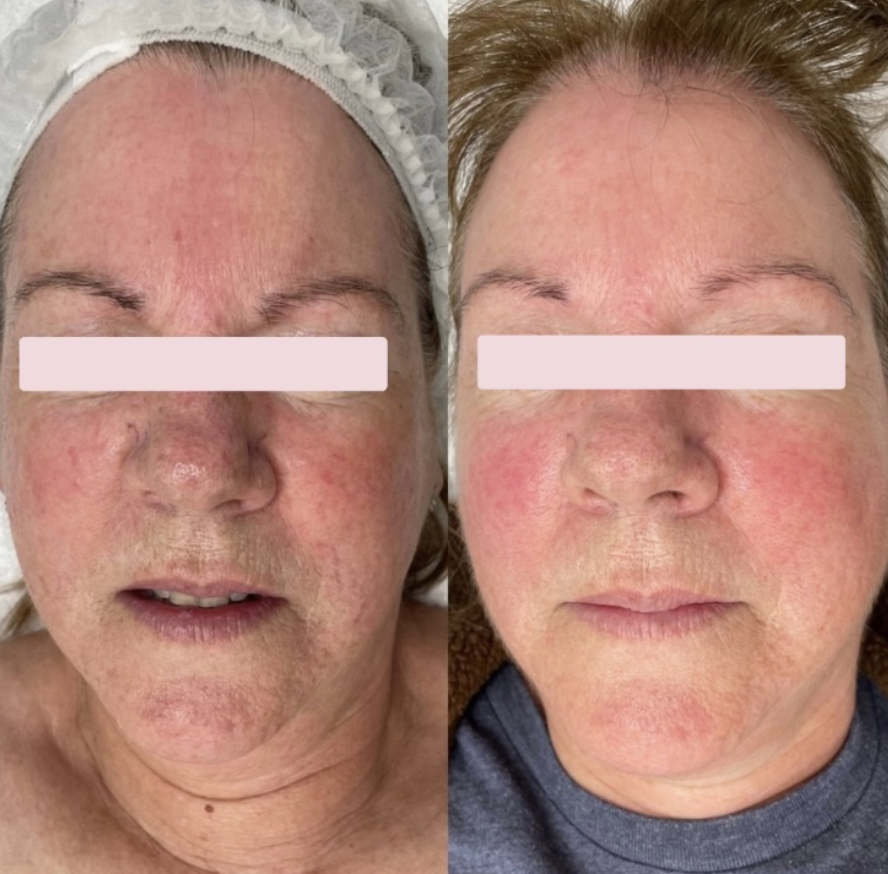 Client skin results before and after treatment at The Skin Bar and Lounge