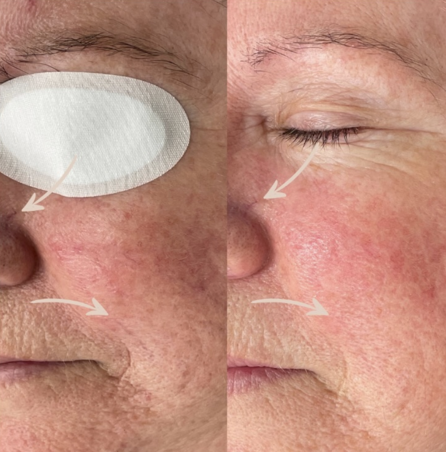 Client skin results before and after treatment at The Skin Bar and Lounge