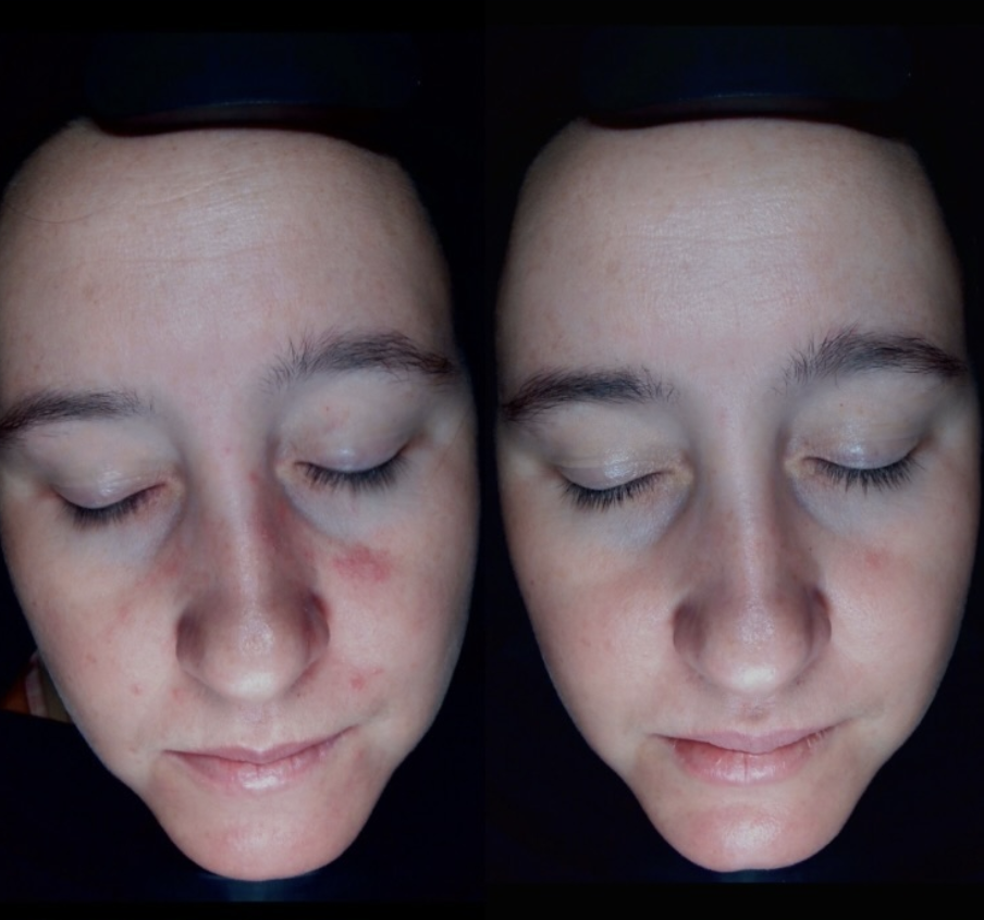 Client skin results before and after treatment at The Skin Bar and Lounge